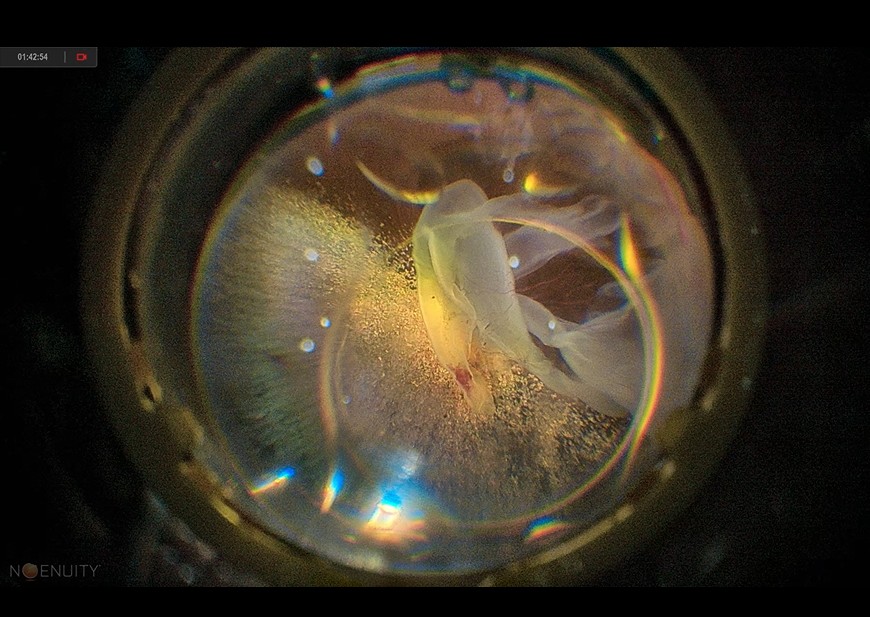 硝子体手術
