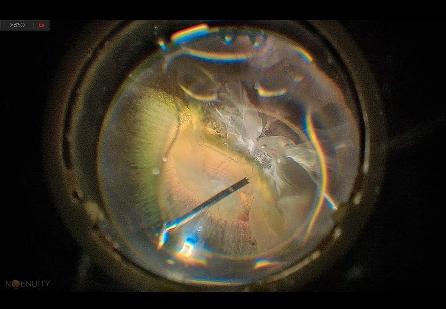 硝子体手術